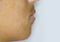治療後（下顎前突～受け口）