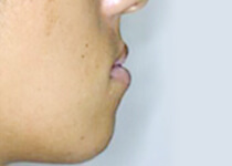 治療前（下顎前突～受け口）