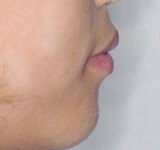 治療前（上下顎前突～出っ歯・口元の突出）