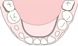 リンガルアーチ(固定式矯正装置)