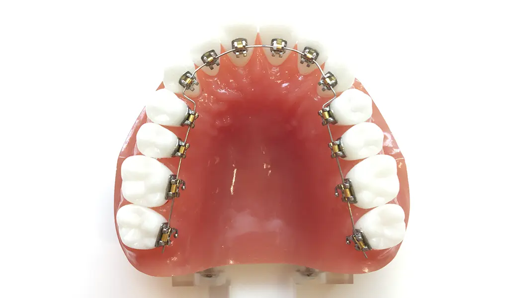 当医院が使用するリンガルブラケット矯正装置(クリッピーL)とは