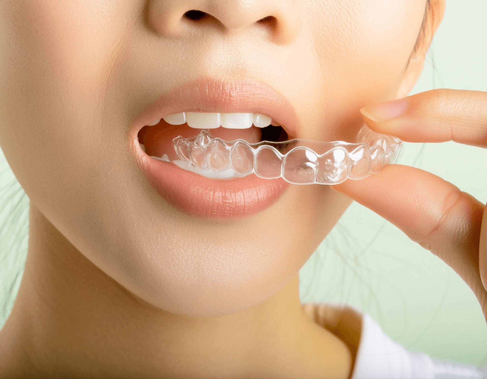 マウスピース矯正の失敗を避け効果を高めるポイント