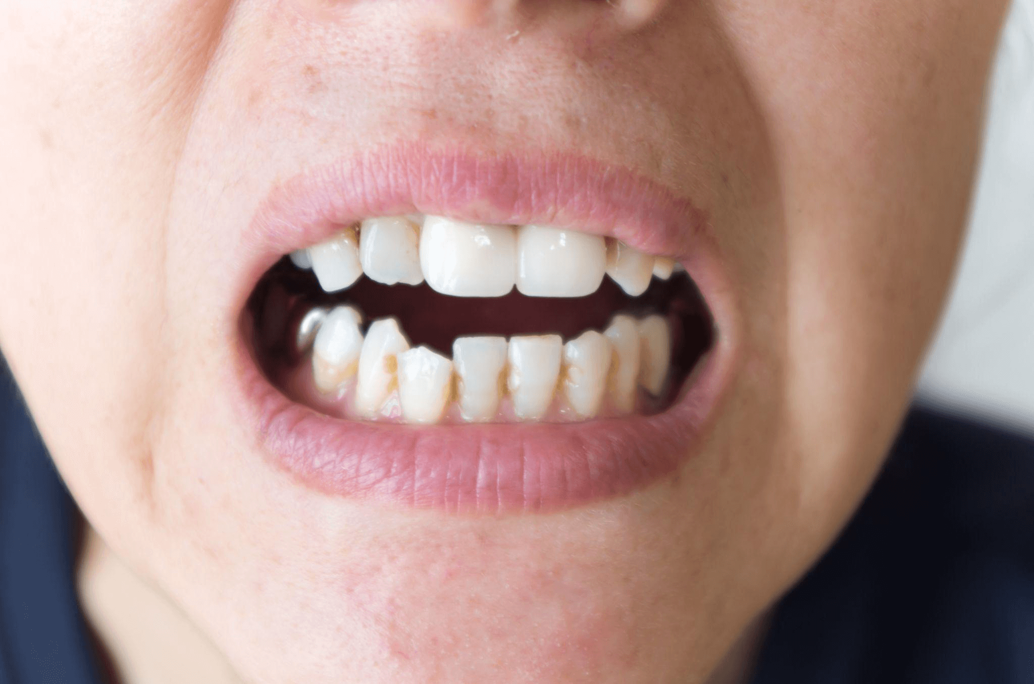 部分矯正で前歯の重なりが治せないケース