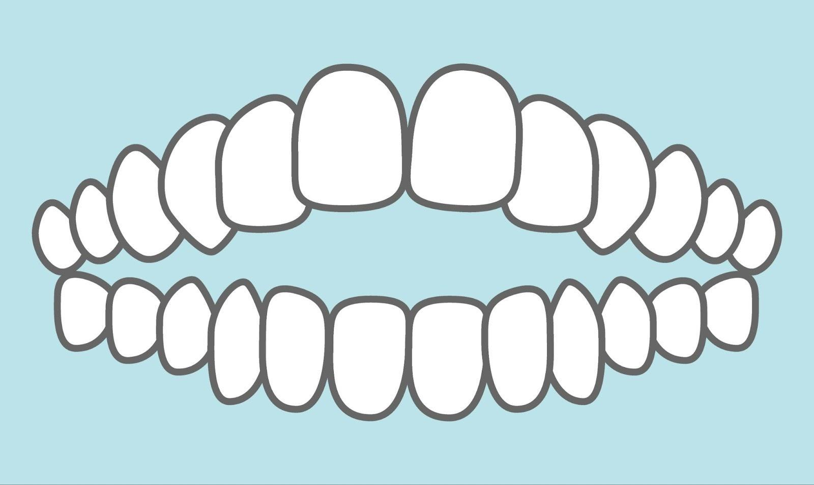 開咬(オープンバイト)とは
