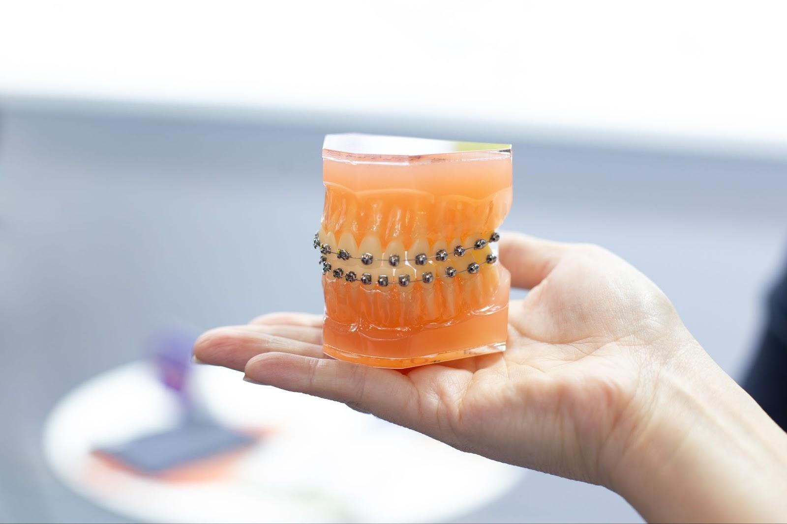 矯正歯科での開咬の治療方法