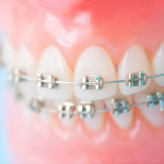 1期治療でワイヤー矯正はできる？かかる期間や費用も解説