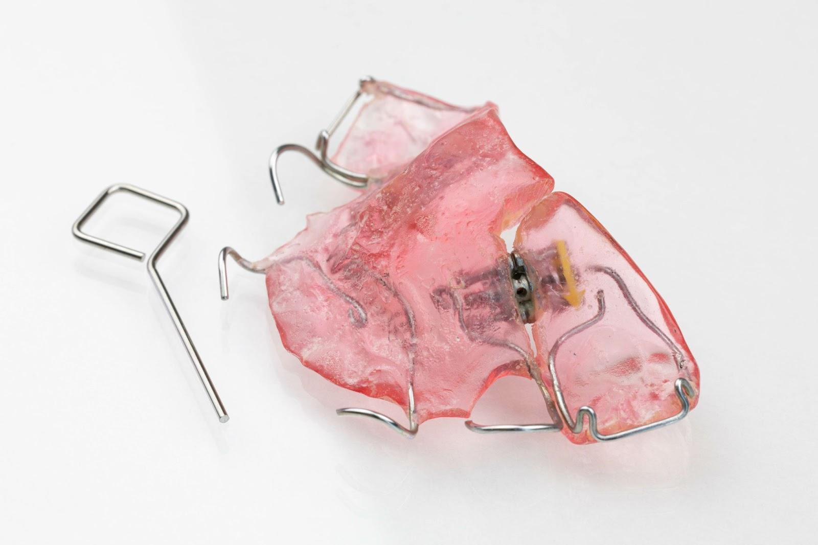 1期治療・2期治療で使われる矯正装置