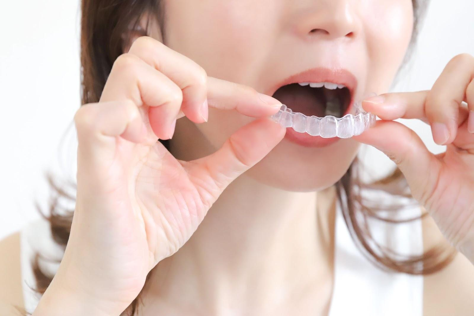 リテーナーとは？