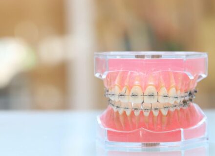 歯科矯正は保険適用になる？対象ケース・手続き・自費でも損しないコツを徹底解説