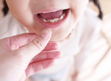 子供の歯列矯正が必要なレベルとは?小児矯正から始めるメリットも解説