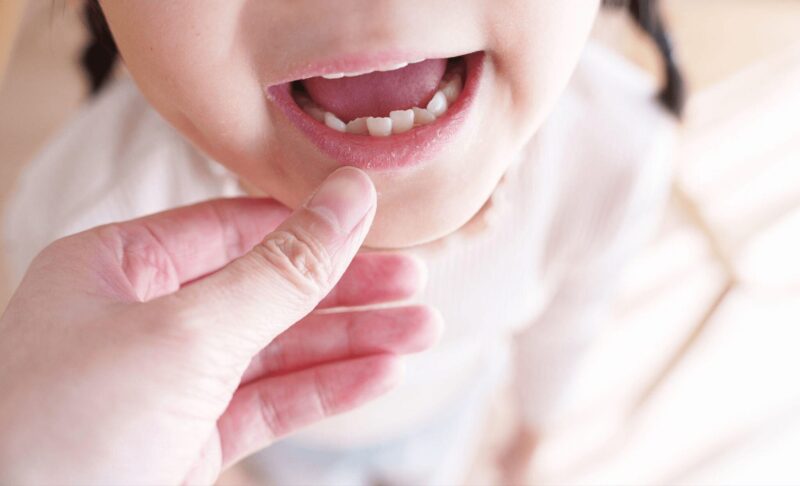 子供の歯列矯正が必要なレベルとは?小児矯正(1期治療)から始めるメリットも解説