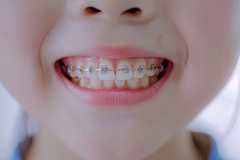 子供の歯列矯正には2種類ある