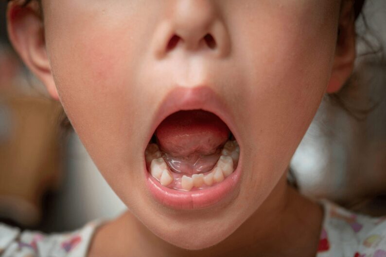 子供の歯並びで歯列矯正が必要となるケース