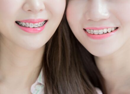 歯列矯正で歯が動きやすい人・動きにくい人の特徴は？今日からできる動きやすくする工夫
